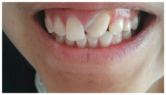 宜兴矫正龅牙的费用要多少