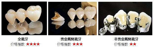 宜兴做烤瓷牙收费贵不贵