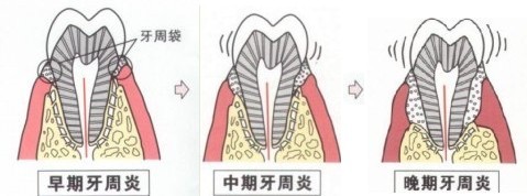 牙周炎不治疗什么后果