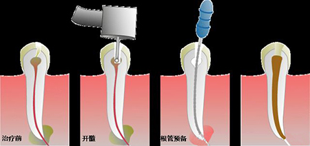 宜兴根管治疗一般要多久